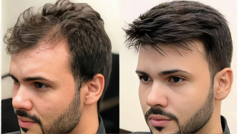 How to Maintain Your Hair Patch in South Delhi.