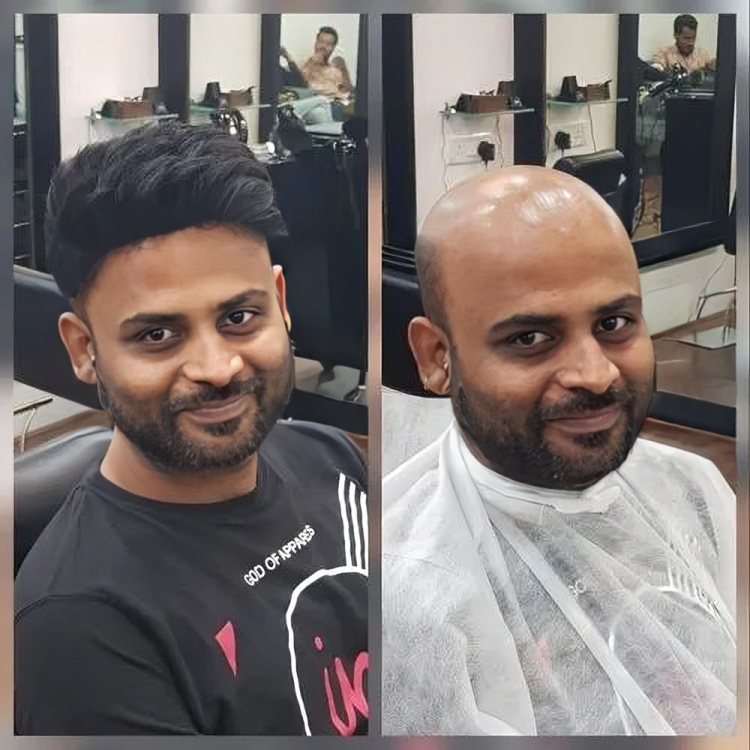 Non-Surgical Hair Replacement in Model Town.