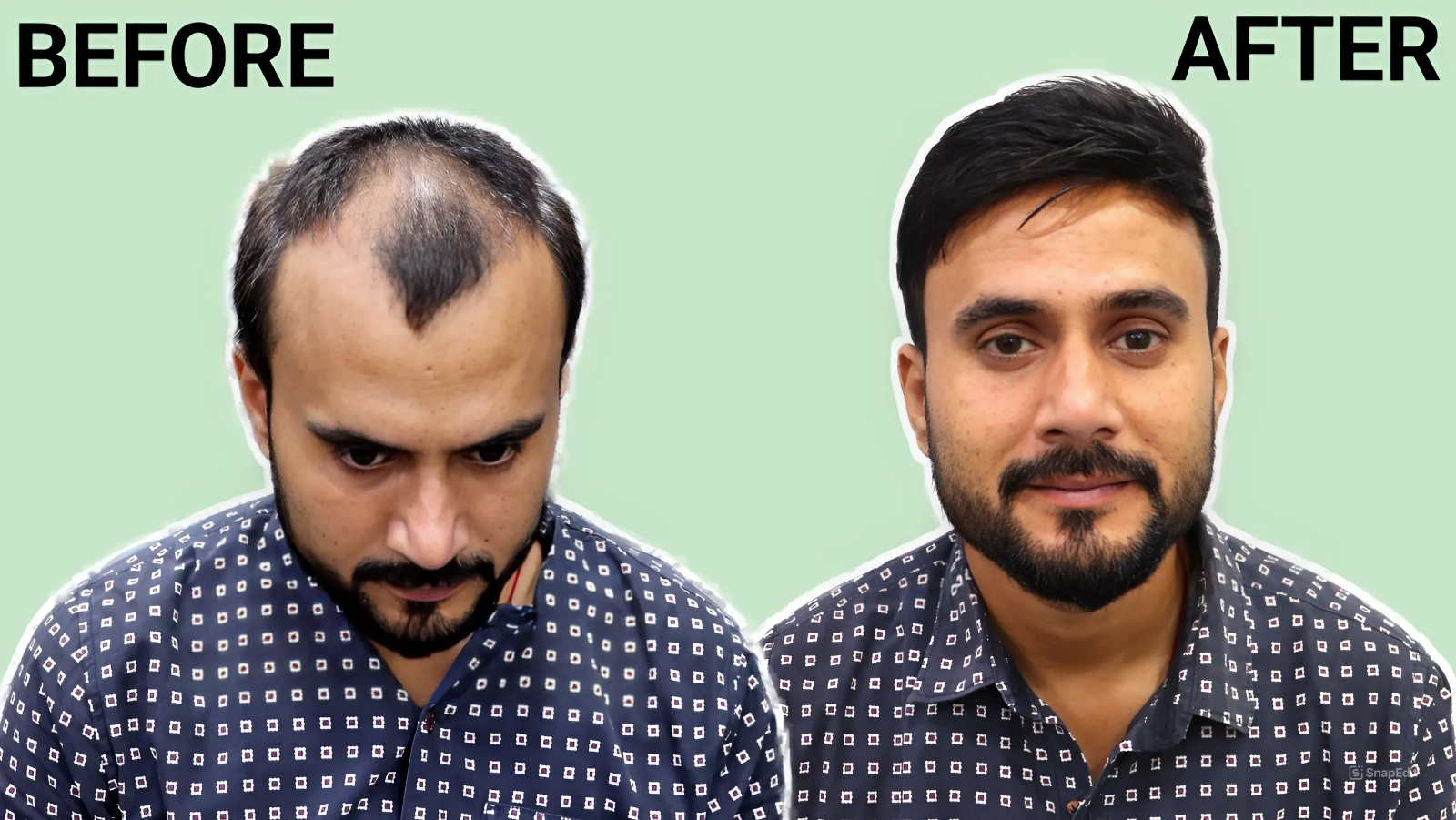 best hair patch service in Delhi.