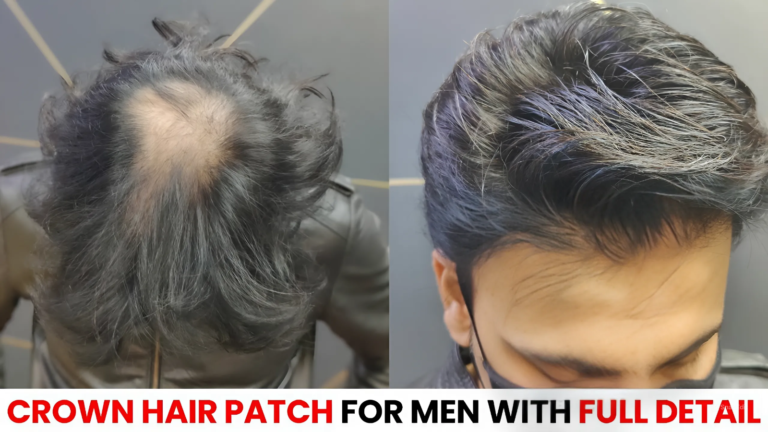 How to Choose the Best Hair Patch Service in South Delhi.