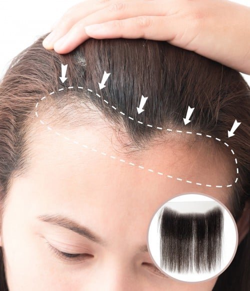 How to Find Affordable Hair Patch Services in Delhi.
