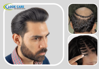 Step-by-Step Guide to Choosing a Hair Patch Service in Delhi.