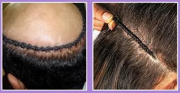 Hair Weaving Treatment in Lajpat Nagar